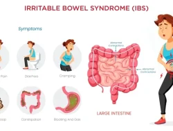 Apa penyebab sindrom iritasi usus besar ibs