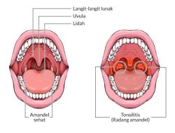 Apa perbedaan radang tenggorokan dan radang amandel