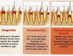 Apa tanda-tanda penyakit periodontal pada gusi
