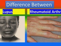 Bagaimana cara membedakan lupus dan rematik