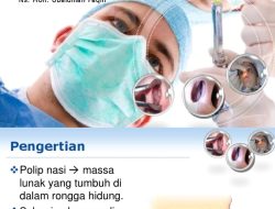 Bagaimana cara mengatasi hidung polip tanpa operasi