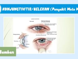 Bagaimana cara mengatasi konjungtivitis belekan yang menular