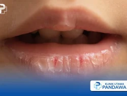 Kenapa bibir sering kering dan pecah-pecah