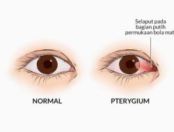 Kenapa bintik kuning pterygium muncul di mata