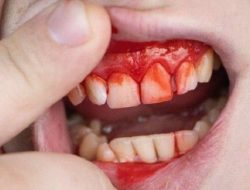 Kenapa gusi berdarah saat menggosok gigi