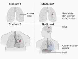 Kenapa kanker paru-paru sering terdeteksi pada stadium lanjut
