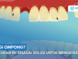 Mengapa Gigi Tanggal di Usia Dewasa Bukan Hal yang Normal: Penyebab, Pencegahan, dan Solusinya
