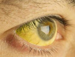 Mengapa Mata Menguning pada Penderita Hepatitis? Memahami Gejala Ikterus dan Kerusakan Fungsi Hati