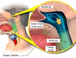 Mengenal Kanker Nasofaring: Gejala, Penyebab, Pengobatan, dan Pencegahannya