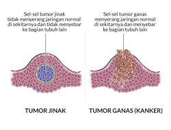 Mengenal Perbedaan Benjolan: Bagaimana Cara Membedakan Tumor Jinak dan Ganas?
