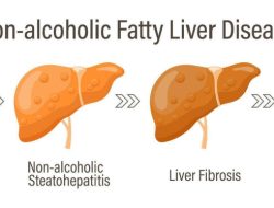 Mengenal Perlemakan Hati: Apa Penyebab Hepatitis Lemak Fatty Liver Non-Alkoholik?