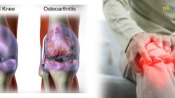 Pengaruh Cuaca Terhadap Sendi: Mengapa Cuaca Dingin dan Hujan Memperburuk Gejala Osteoarthritis?